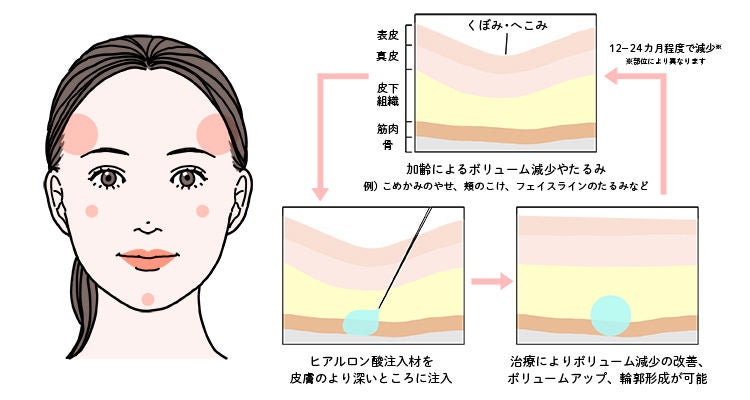 ヒアルロン酸注入治療の仕組み