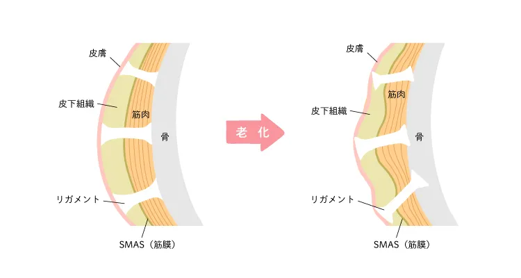 たるみの原因となるリガメントの変化