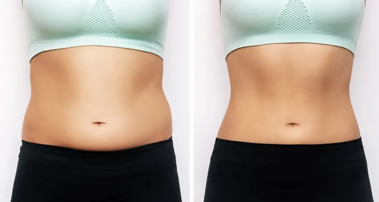 Reduce subcutaneous fat and improve your body shape