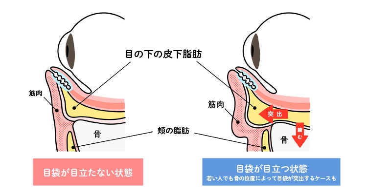 目の下のたるみの要因は加齢による目元の筋肉の変化