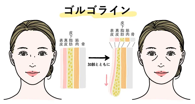ゴルゴ線(ゴルゴライン)の根本的な原因、肌のたるみが起きる説明図