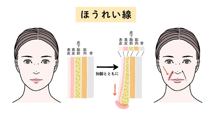 加齢による肌のたるみやハリ不足でほうれい線が目立つ