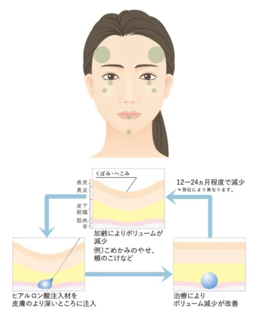 ヒアルロン酸注入が効果的な部位1の画像