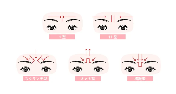 眉間のしわの種類