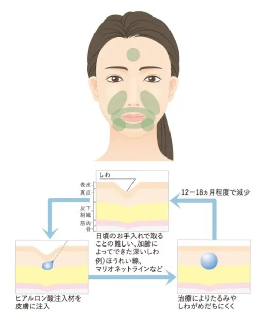 ヒアルロン酸注入が効果的な部位2の画像