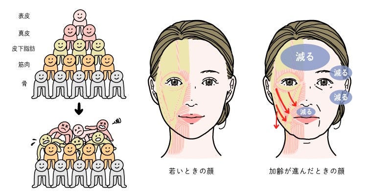 顔の脂肪が加齢とともに減少し、下垂する様子をピラミッドのイラストと顔のイラストで示した図