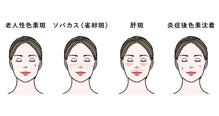 シミは大きく分けて老人性色素斑・ソバカス・肝斑・炎症後色素沈着の4種類