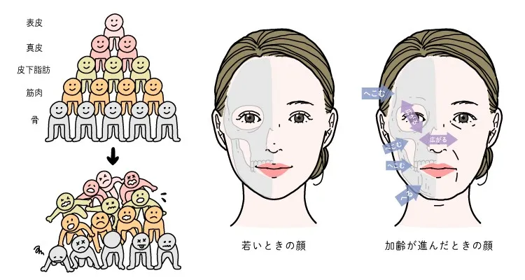 加齢によって顔の骨の骨密度が減り、縮むことで皮膚が垂れ下がる