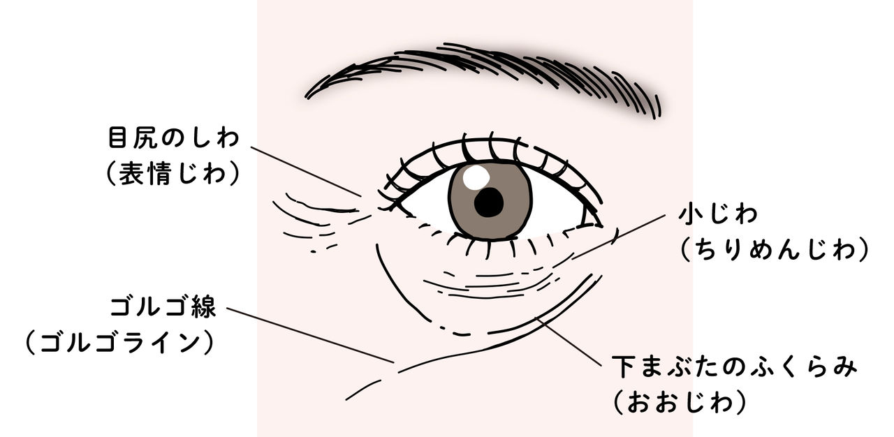 目の下のしわの種類