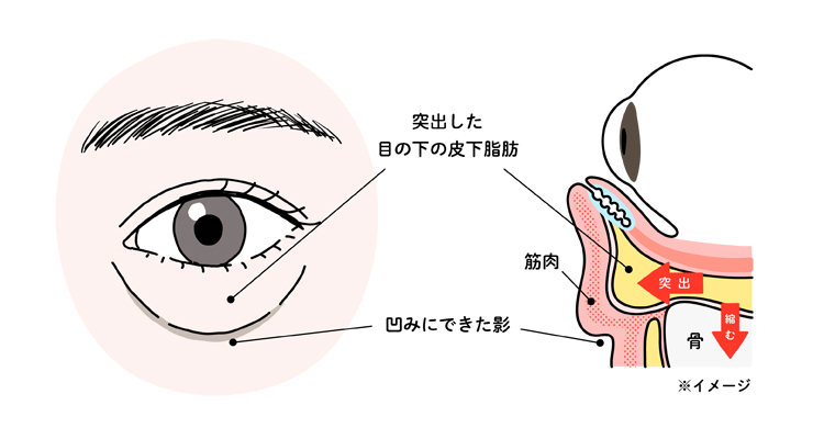 目の下のたるみは骨や筋肉、皮下脂肪の加齢による変化で起こる