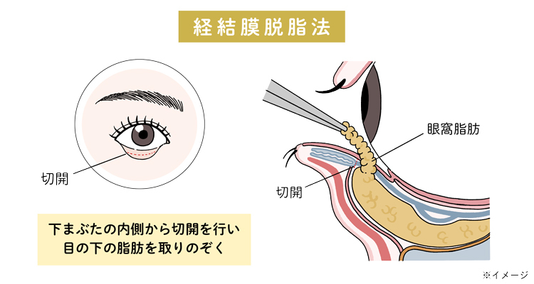 経結膜脱脂法