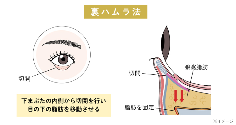 裏ハムラ法