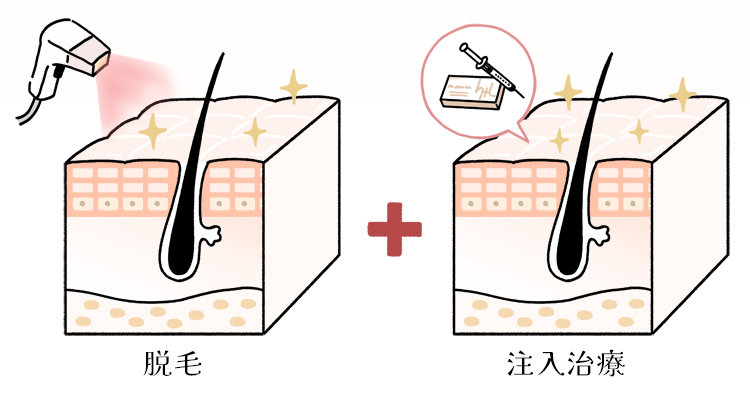 脱毛と注入治療の組み合わせ