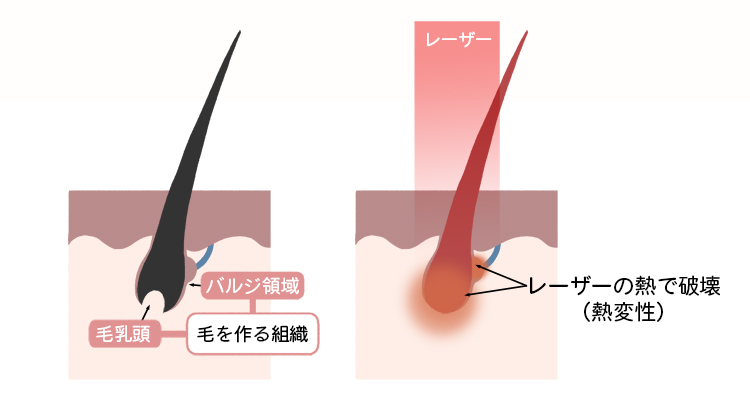 医療脱毛の仕組み