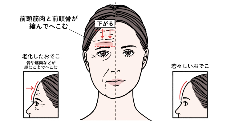 老化したおでこと若々しいおでこの比較