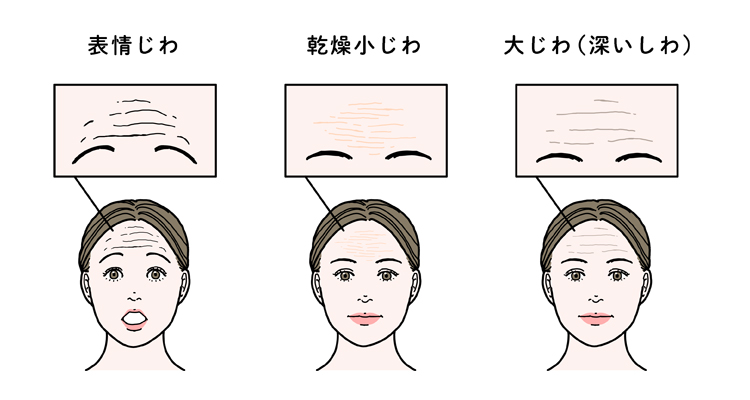 おでこの表情じわ、乾燥小じわ、大じわ（深いしわ）