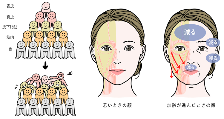 加齢が進むと皮下脂肪の量が減少して、移動するイメージ