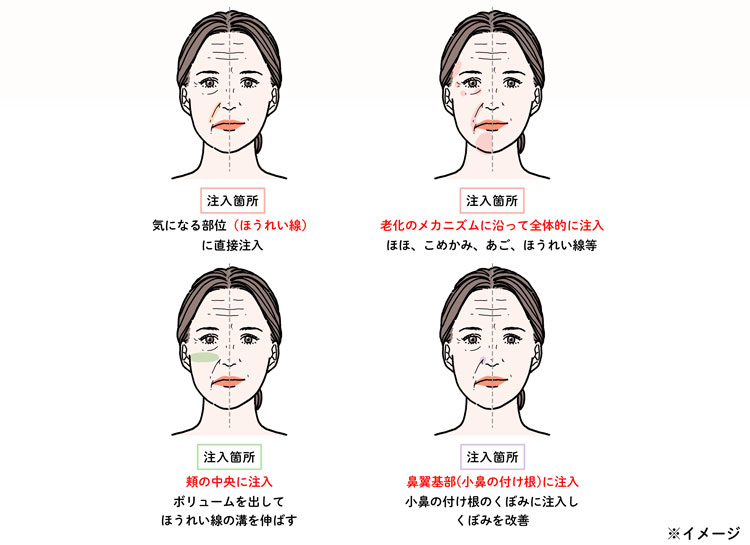 ヒアルロン酸を注入する箇所の4つの例