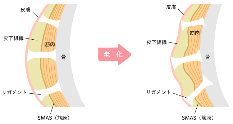 支持靭帯（リガメント）の衰えやゆるみによりたるんだ皮下脂肪を塞ぎ止めるイメージ