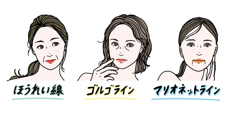 ほうれい線、ゴルゴライン、マリオネットライン