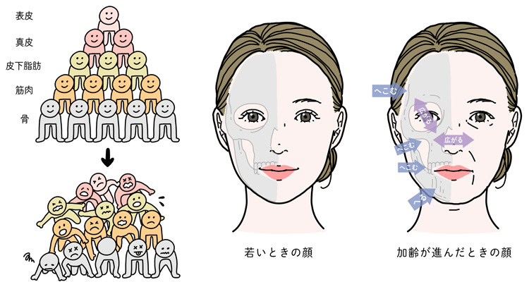 骨の萎縮と脂肪の下垂による顔の構造変化を表したイラスト