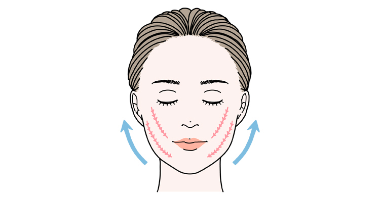 糸リフトによる治療をイメージしたイラスト