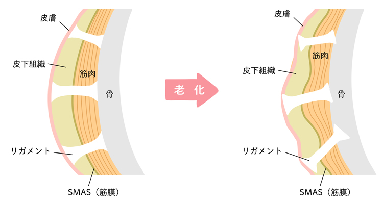 支持靭帯とSMASの衰えによって顔のたるみは生じる