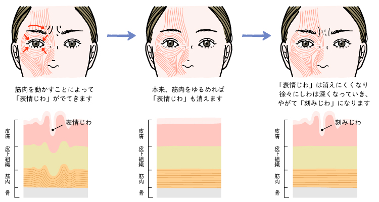 表情じわが刻みじわになるメカニズム