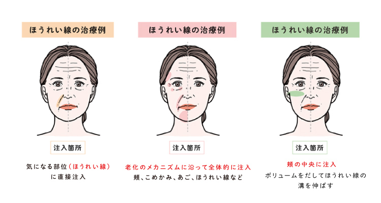 ほうれい線の治療例