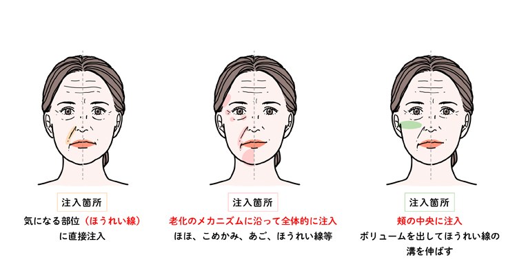 ほうれい線治療を例にした、注入治療の注入方法の変遷