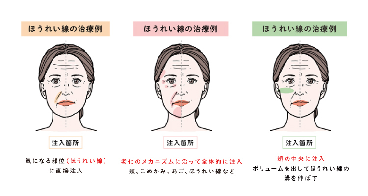 ほうれい線治療を例にした、注入治療の注入方法の変遷