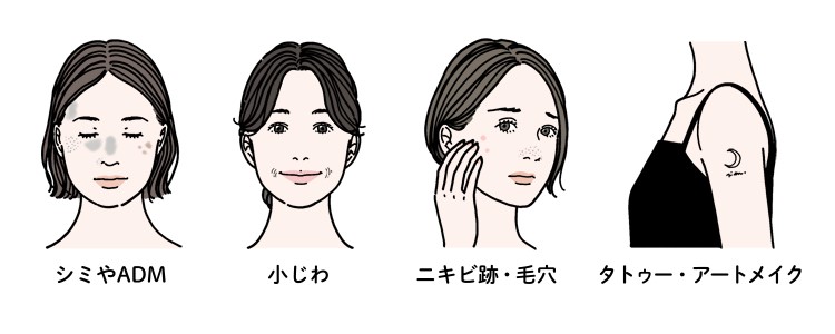 ピコレーザーに期待できる効果（シミやADM、小じわ、ニキビ跡、毛穴、タトゥー、アートメイク）