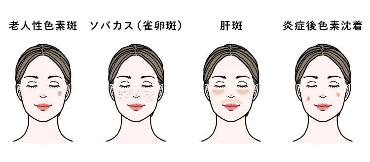 老人性色素斑、ソバカス、炎症後色素沈着、肝斑