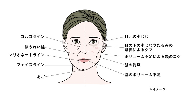 ヒアルロン酸注入治療によって改善が期待できる部位