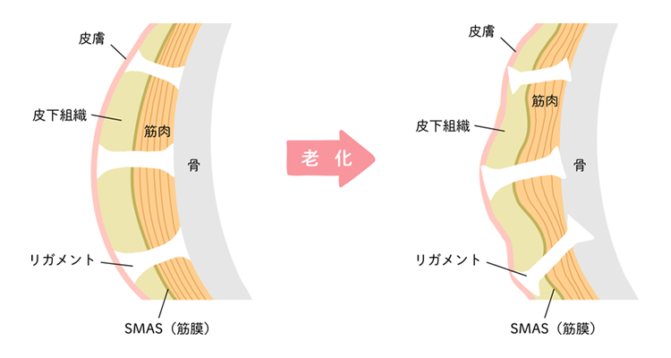 加齢と共に支持靭帯とSMASが衰える