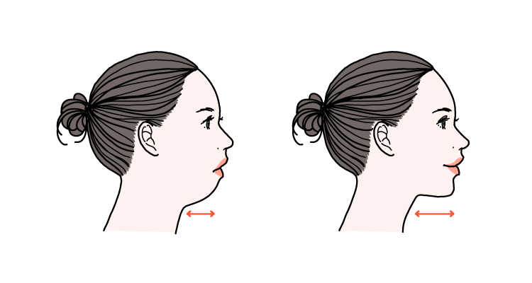 あご先にヒアルロン酸を注入すると、横顔のバランスやフェイスラインが整って小顔に見える