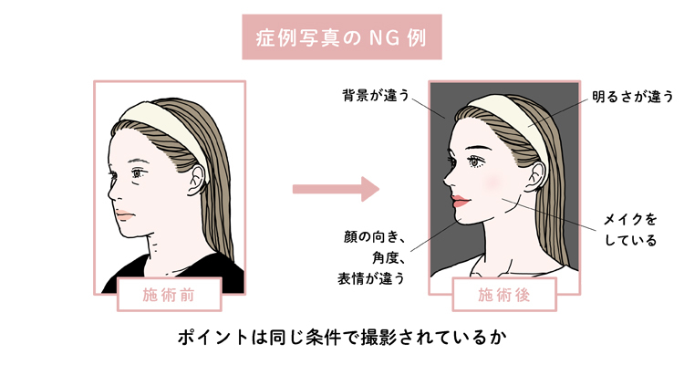症例写真における撮影条件のNG例を示す比較イラスト